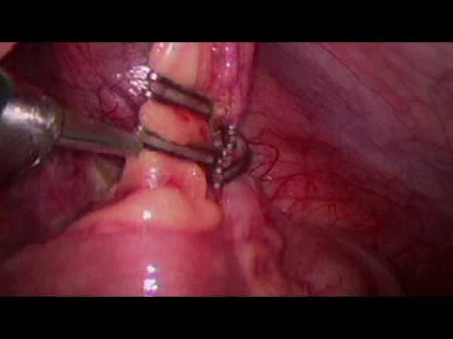 DS Ligation Clip System for Laparoscopic Appendectomy