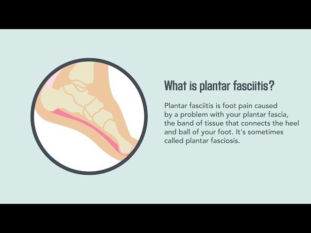 Plantar Fasciitis: Causes, Symptoms, and Treatment | Merck Manual Consumer Version