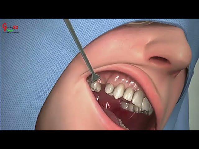 Teeth Planting Surgery #Teeth #Surgery #gamer #gaming92