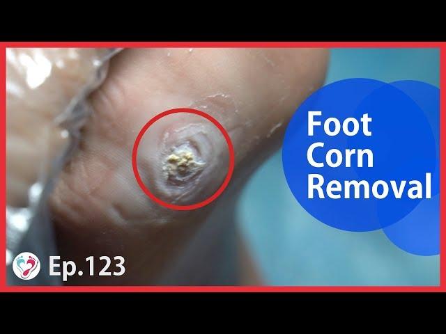 TOP MEDICAL PEDICURE Ep.123 - Foot Corn Treatment By Shaving and Dressing