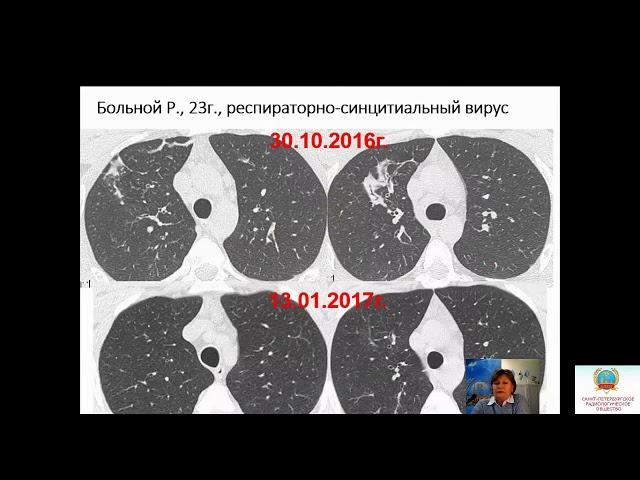 Сперанская А.А."Острые интерстициальные пневмонии вирусного генеза: что должен увидеть рентгенолог""