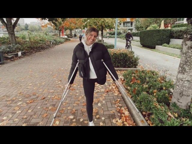 Amputee woman inspires others with viral video after surgery that changed her life