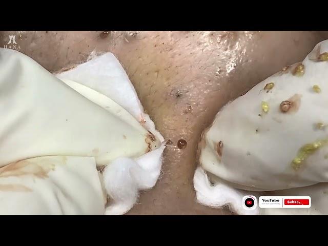 Big Cystic Acne Blackheads Extraction Blackheads & Milia, Whiteheads Removal Pimple Popping