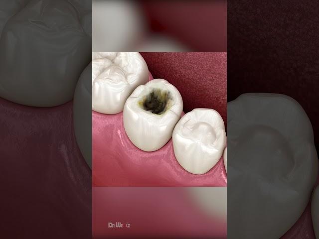 Composite Dental Fillings: ASMR