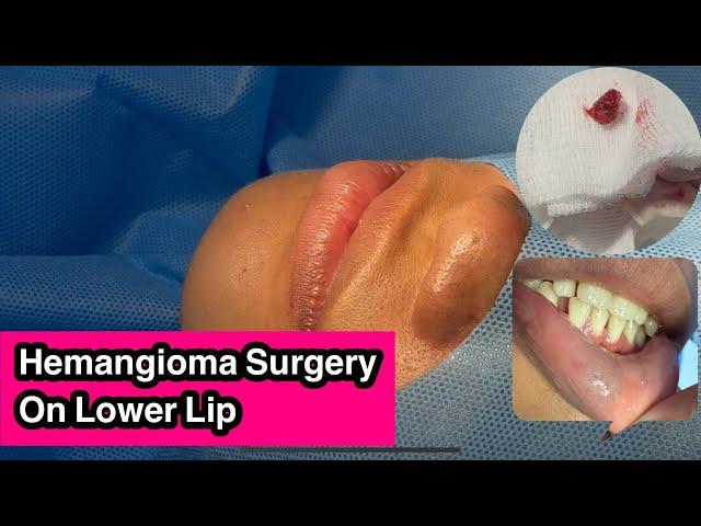 Hemangioma Excision On Lower Lip