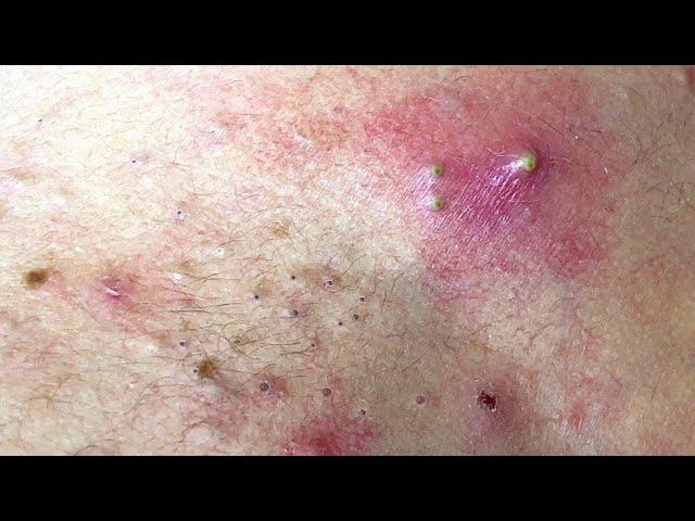 ACNE CLEANING - KNISH TV  #kinishacne #1