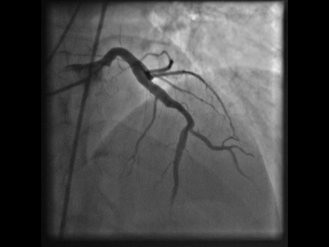 Figure 4: A depiction of the significant progress - complete resolution of the clot