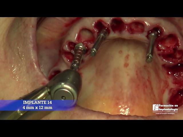 IMPLANTES INMEDIATOS · REHABILITACIÓN MAXILAR · DR ISMAEL SORIANO - FORMACIÓN EN IMPLANTOLOGÍA