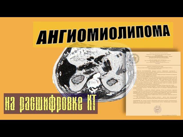 ОЧАГОВЫЕ образования печени на РАСШИФРОВКЕ КТ брюшной полости.  АНГИОМИОЛИПОМА печени.