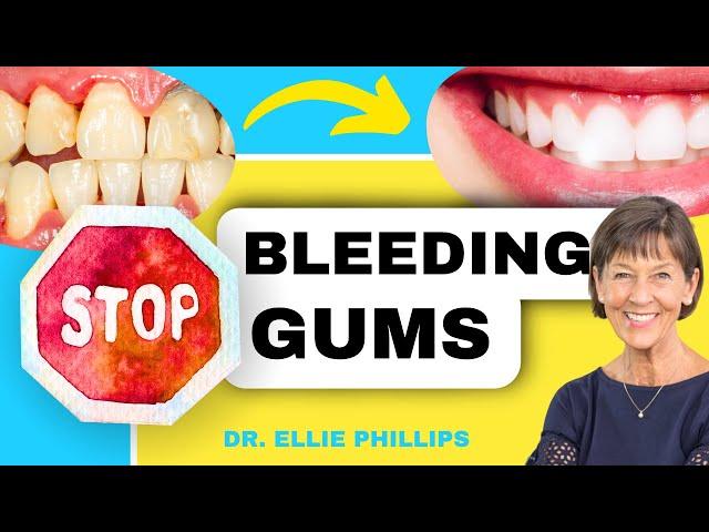 How To QUICKLY Treat Gingivitis and Bleeding Gums