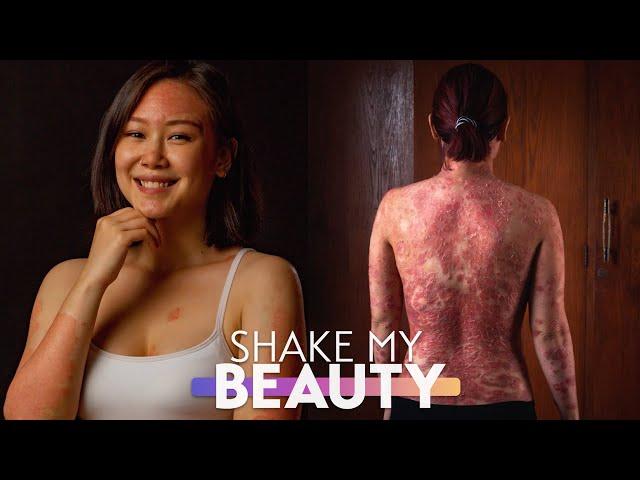 I’m Done Hiding My Psoriasis | SHAKE MY BEAUTY