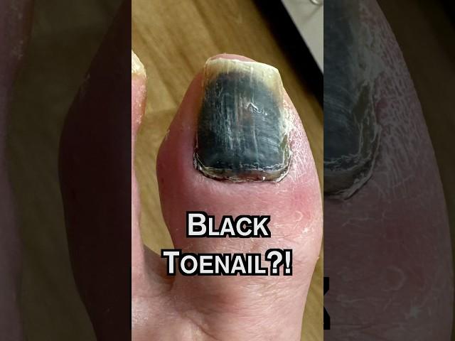 Why is my TOENAIL BLACK?! 