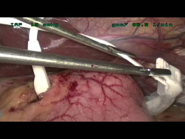 Magenband OP, Lehrvideo / Educational:  / Gastric band surgery