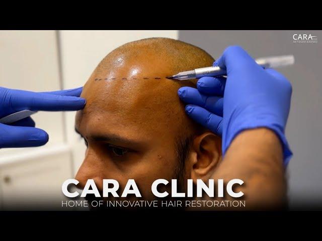 CARA Hair Transplant : Home of Innovative Hair Restoration