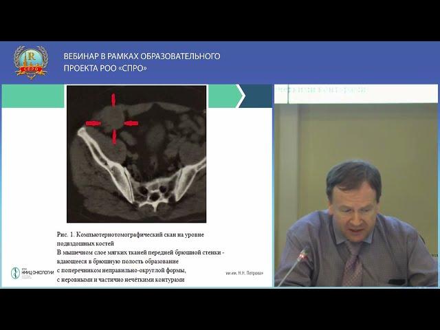 Стандартное мультимодальное УЗИ в современной диагностике опухолей мягких тканей