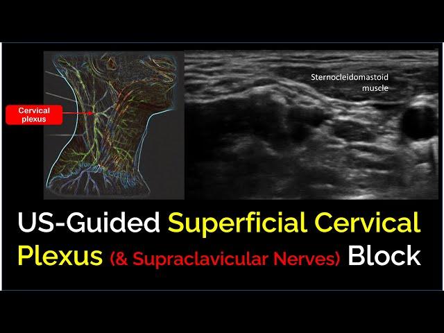 Superficial Cervical Plexus Block - a "How-To" Guide