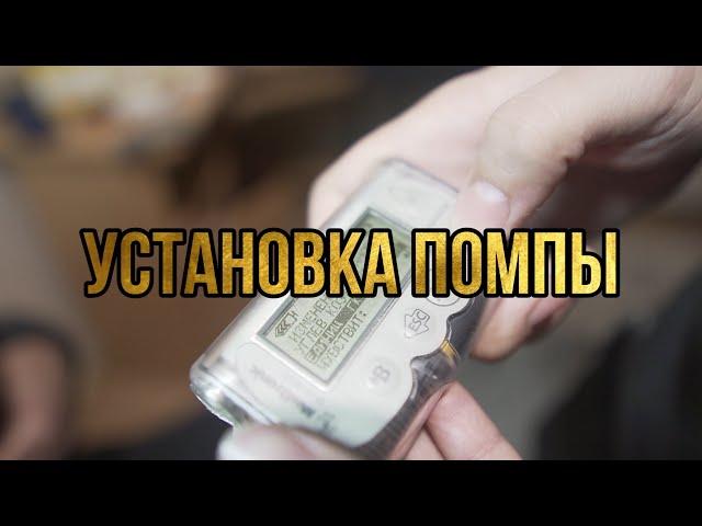 Установка инсулиновой помпы