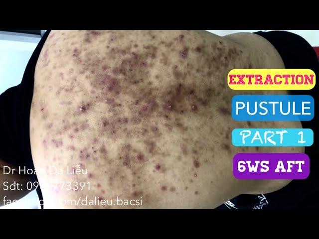 Mụn trứng cá mủ đầy lưng|Dermatologist,pimples, blackhead,pustule full back extraction 6ws after