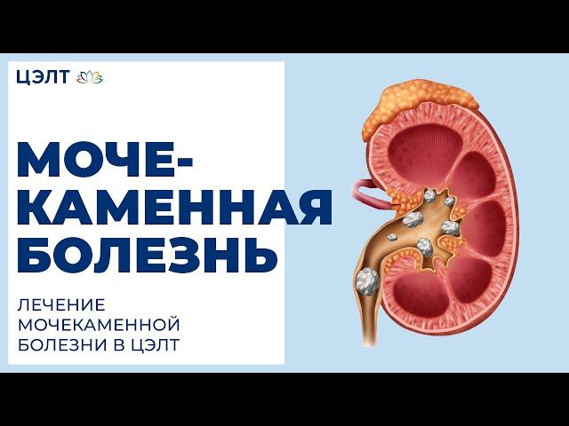  Мочекаменная болезнь. Лечение мочекаменной болезни в ЦЭЛТ