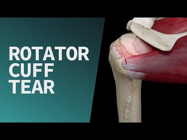 Rotator Cuff Tear