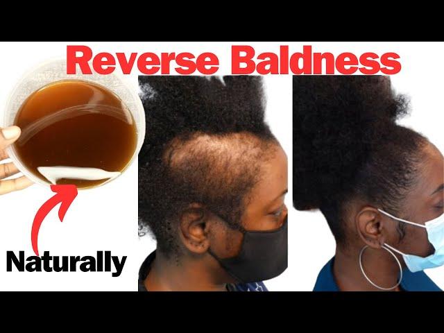 These 3 Herbs Will Help to Reverse Baldness and Hair Thinning.Try NOW! and See What Happens.