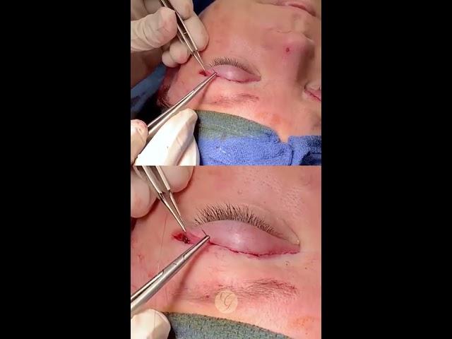 Blepharoplasty "Eyelid Lift" by Plastic Surgeon Dr Kevin Sadati in Newport Beach, Orange County