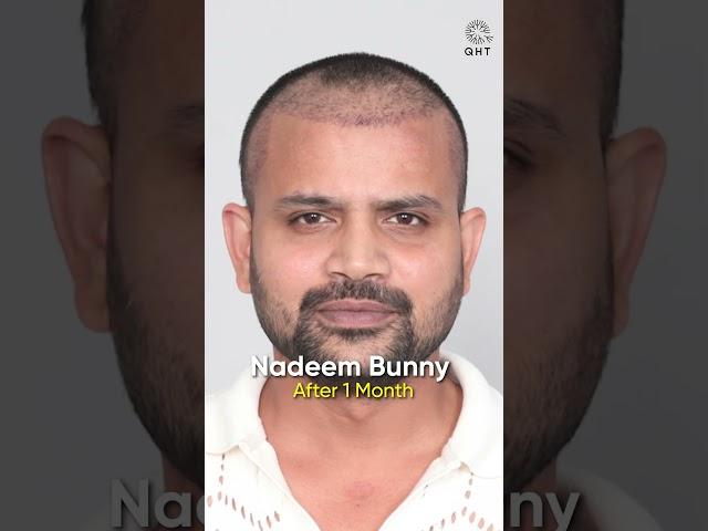 Youtuber Nadeem Bunny (Topa Bhai) 6 Months Hair Transplant Progress #shorts#hairtransplant