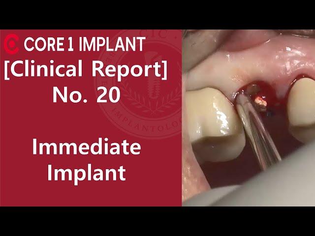 [CYBERMED Clinical Report] #15 Immediate implant