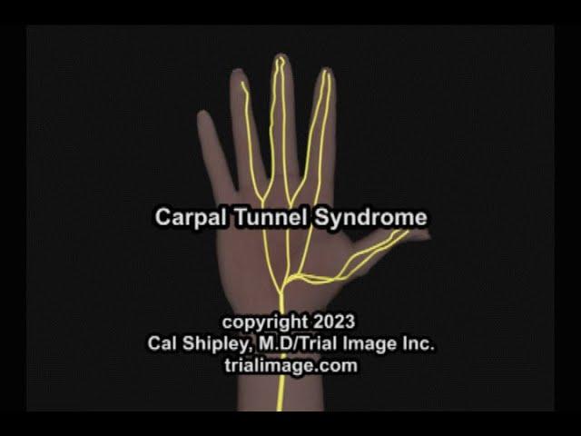 Carpal Tunnel Syndrome by Cal Shipley, M.D.