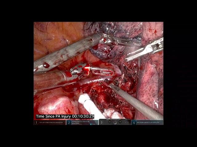 Cerfolio Tips: How to Repair major PA injury Robotically, without Opening or Transfusing Patient