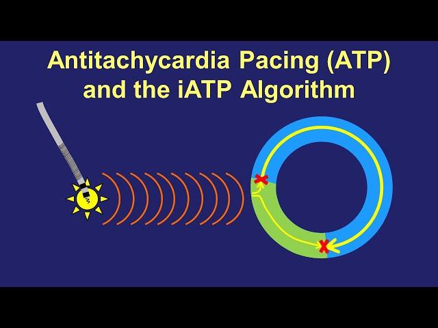 Antitachycardia Pacing (ATP) - How it Works, How to Improve