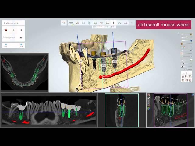 3D BioCAD - 3Shape Implant Studio Step by Step Guide