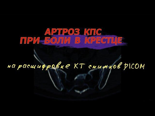 АРТРОЗ крестцово-подвздошных сочленений и БОЛИ В КРЕСТЦЕ после САКРОИЛЕИТА на РАСШИФРОВКЕ КТ