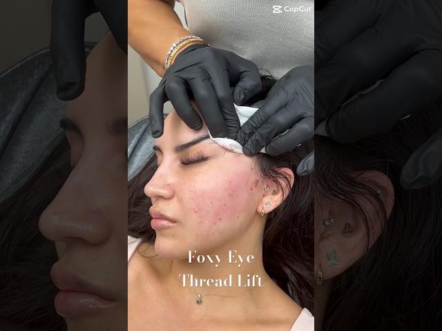 Foxy Eye Thread Lift by Dr Gideon Kwok at Skin Perfect Rancho 🪡 #beauty #threadlift