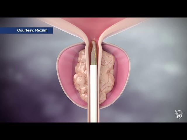 Mayo Clinic Minute: Steam treatment for enlarged prostate