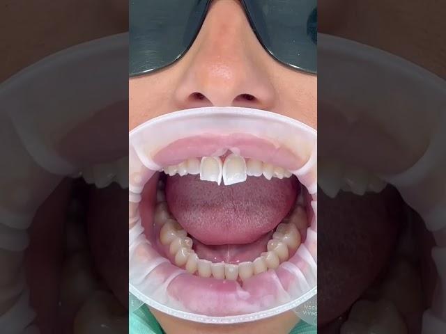 Composite bonding in action.  #cosmeticdentistry #ruhdental