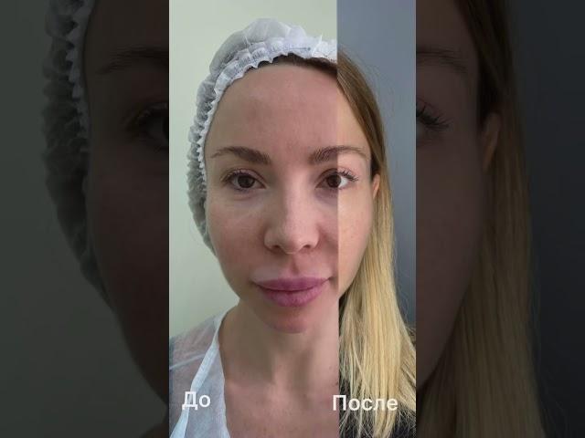 Самая бюджетная пластическая операция... Да, блефаропластика верхних век. Обратите внимание на рубец