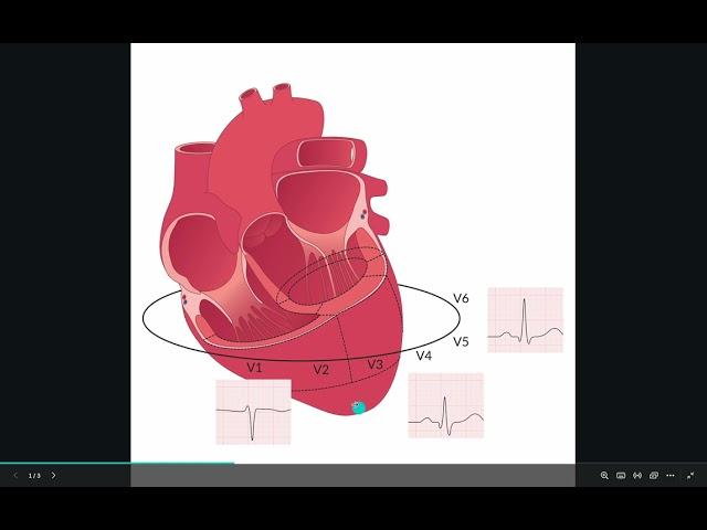 ECG R wave progression in a nutshell (including case discussion)