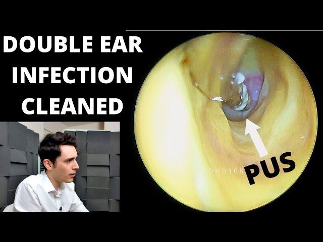 Sloughy Pus Ear Infection Cleaned