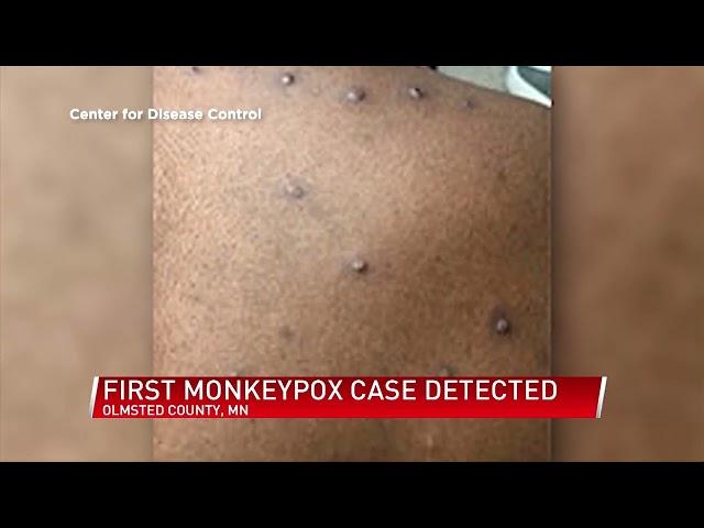 Monkeypox confirmed in Olmsted County