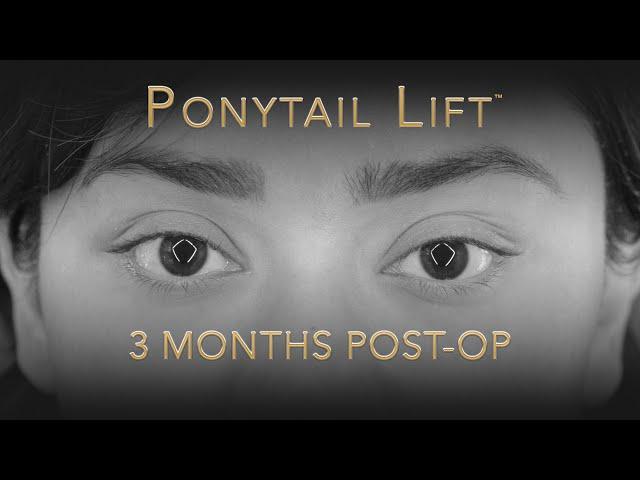 Ponytail Lift | Facelift Before And After Video | How About Those Eyebrows?