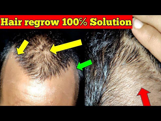 how to regrow hair naturally for men | how to regrow hair in bald area | How to regrow hairline