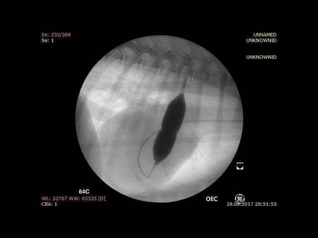 Ballon valvuloplasty of the pulmonary artery. Баллонная вальвулопластика.