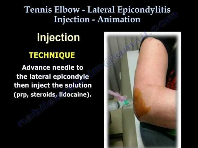 Tennis Elbow Lateral Epicondylitis Injection - Everything You Need To Know - Dr. Nabil Ebraheim