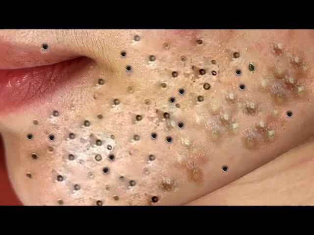 ACNE CLEANING - KINISH TV  #kinishacne 2023 new video #5