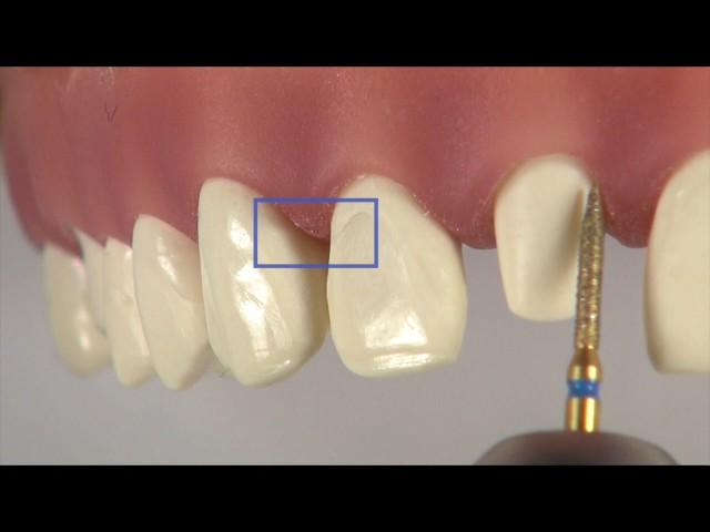 Aperture and Depht of Field in Dentistry, by Stefano Lombardo