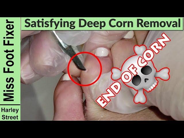 Satisfying and gentle corn removal | foot corn removal By Miss Foot Fixer Marion Yau