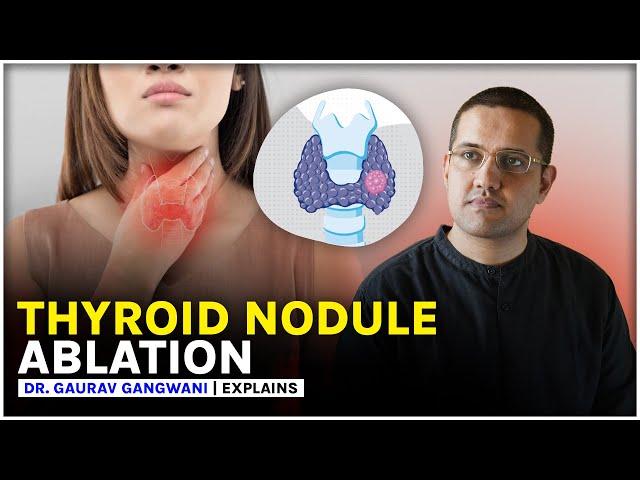 THYROID NODULE TREATMENT WITHOUT SURGERY | THYROID RFA | Dr. Gaurav Gangwani