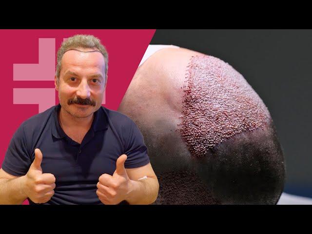 Hair Transplant in Turkey