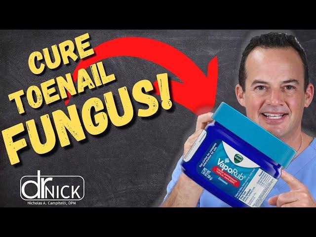 WILL VICK’S VAPORUB KILL TOENAIL FUNGUS!?